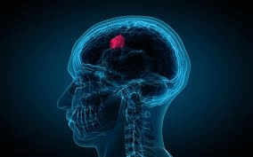 Brain tumor embolization procedure performed by interventional neuroradiologist in Pakistan