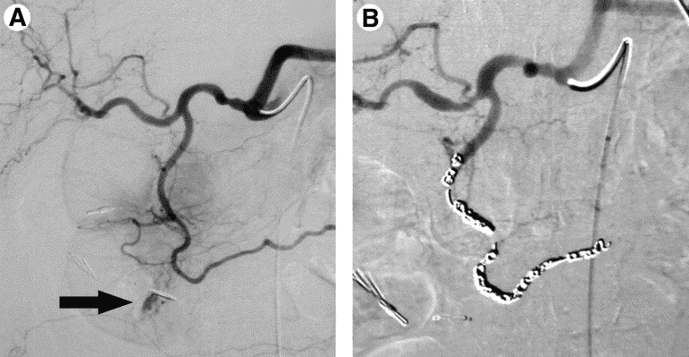 GI bleeding embolization procedure performed by interventional radiologist in Pakistan