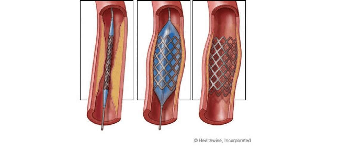 Lower limb angioplasty procedure