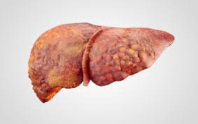 Liver cirrhosis leading to cancer