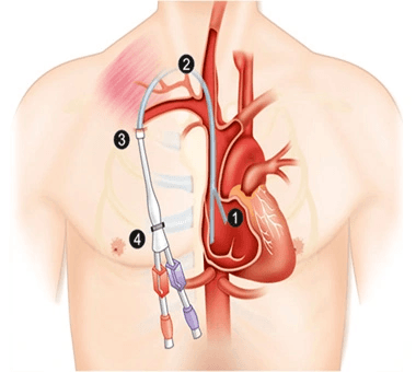 Permacath placement diagram