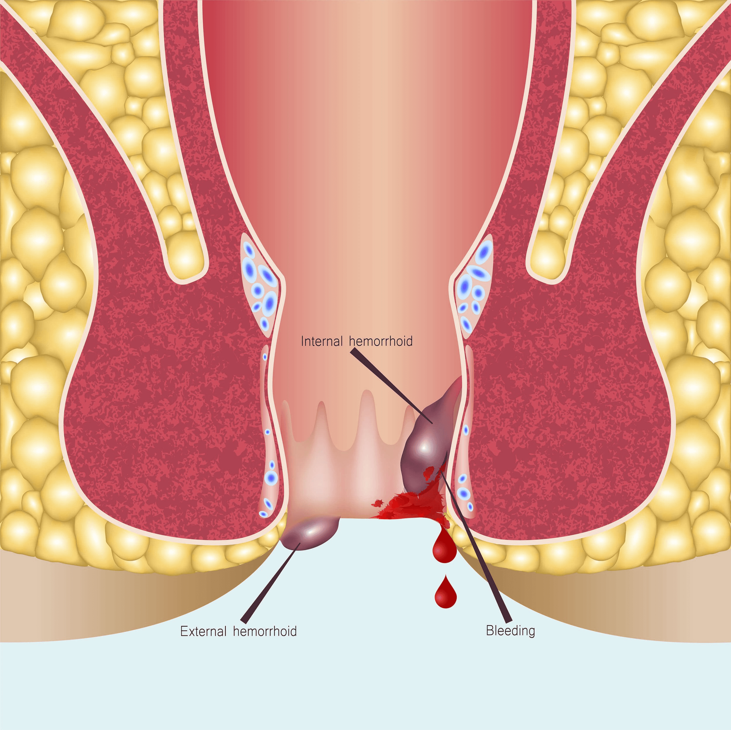 Hemorrhoid embolization procedure performed by interventional radiologist in Pakistan